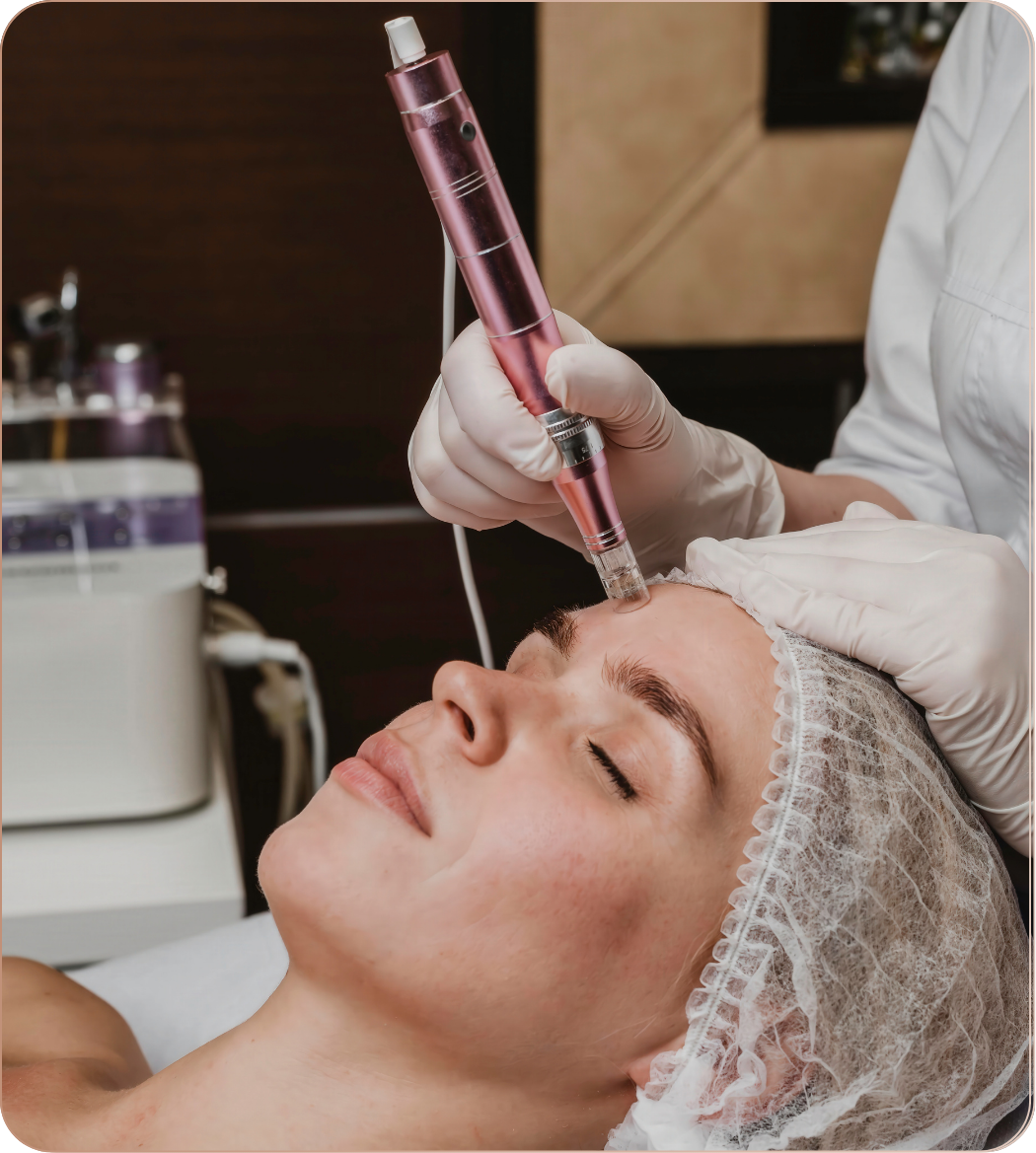 Microagulhamento Facial